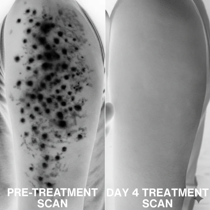 Advanced Triple-Acid Complex for Keratosis Pilaris - Image 3