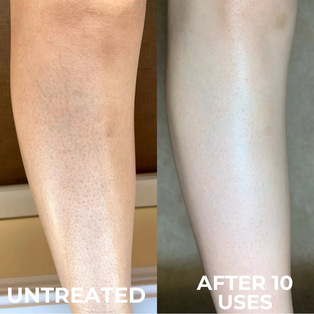 Advanced Triple-Acid Complex for Keratosis Pilaris - Image 4